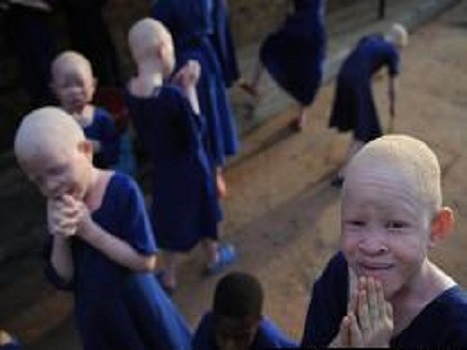 Albino children in Africa